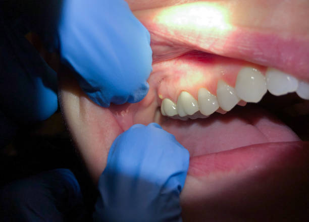 Best Emergency Dental Extractions in Brookston, IN