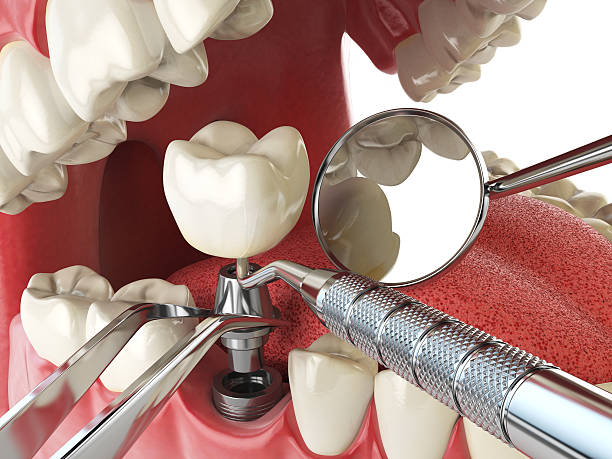 Best Emergency Dentist for Knocked-Out Tooth in Brookston, IN